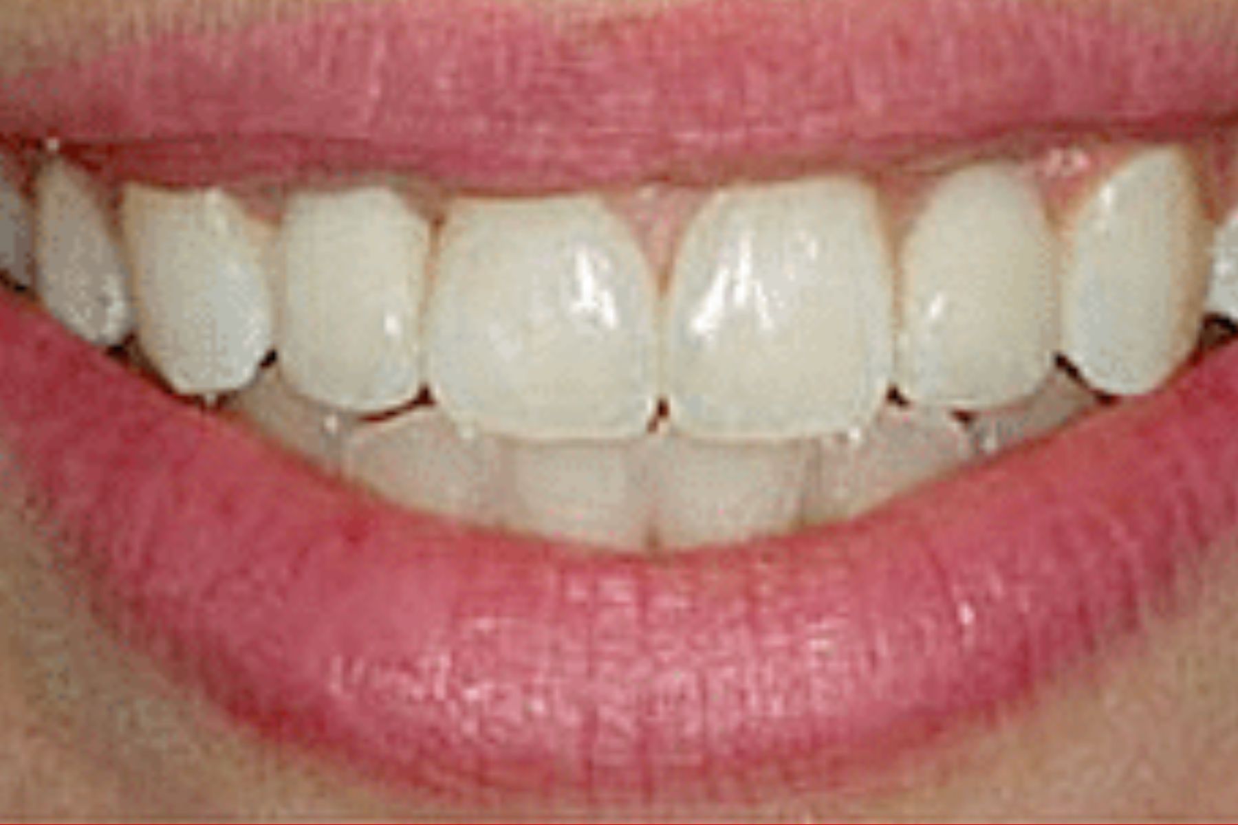 بعد از ایمپلنت