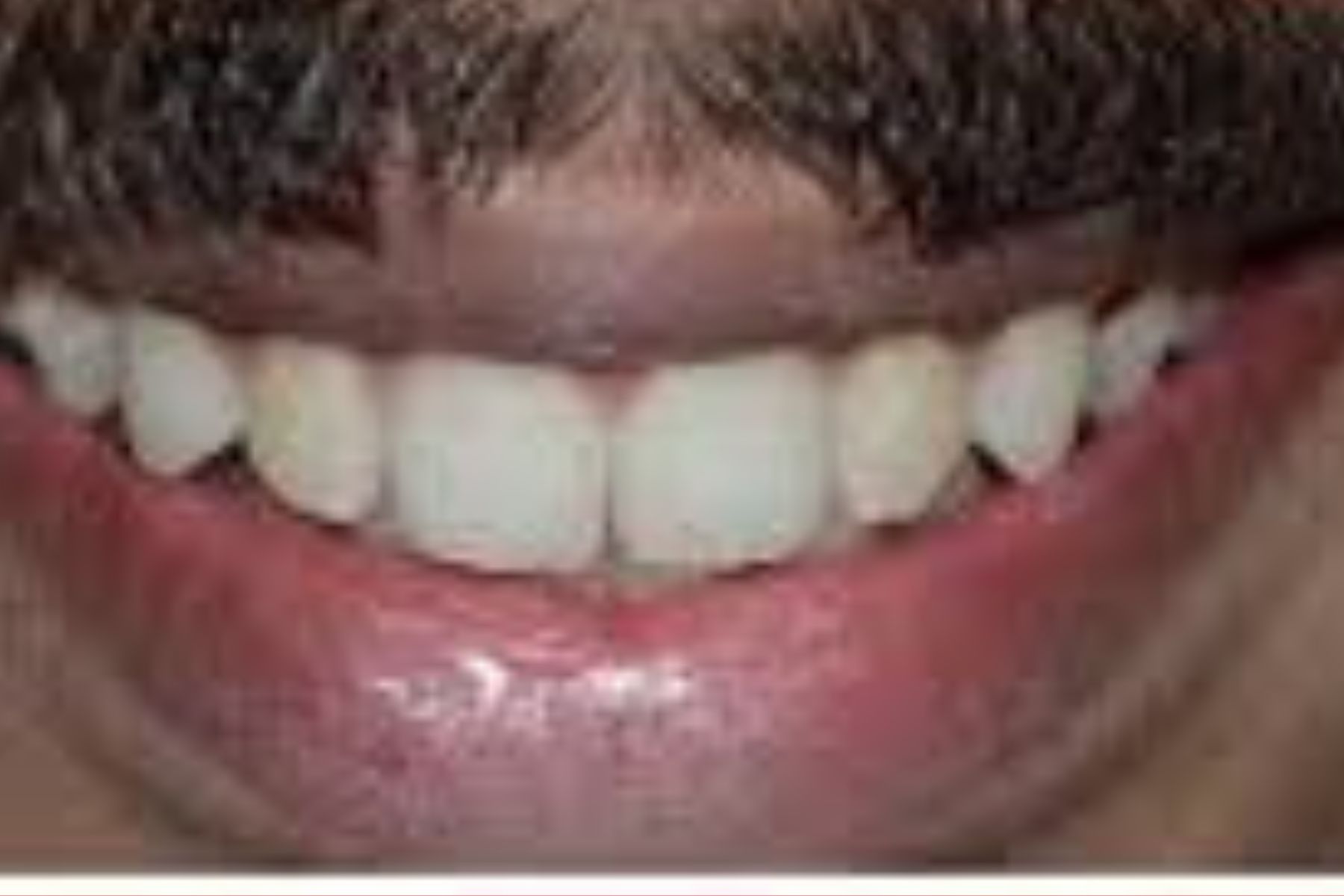 بعد از ارتودنسی