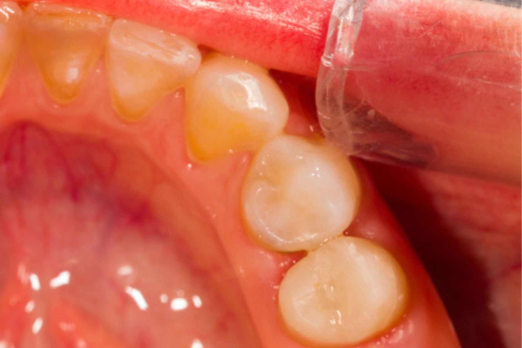 بعد از درمان ریشه 